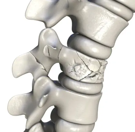 Osteoporotische Wirbelkörperfraktur - Foto © Dr_Microbe - stock.adobe.com