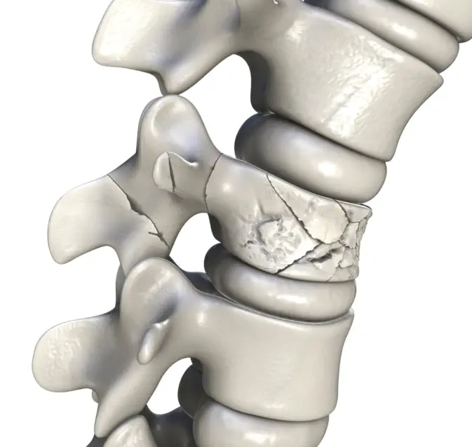 Osteoporotische Wirbelkörperfraktur - Foto © Dr_Microbe - stock.adobe.com